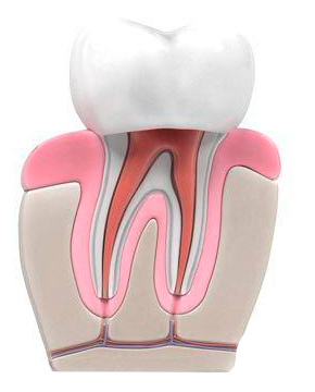 diente_endodoncia_corona