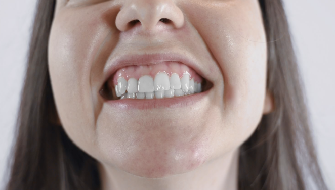 paciente observando encías retraídas y dientes más largos frente al espejo