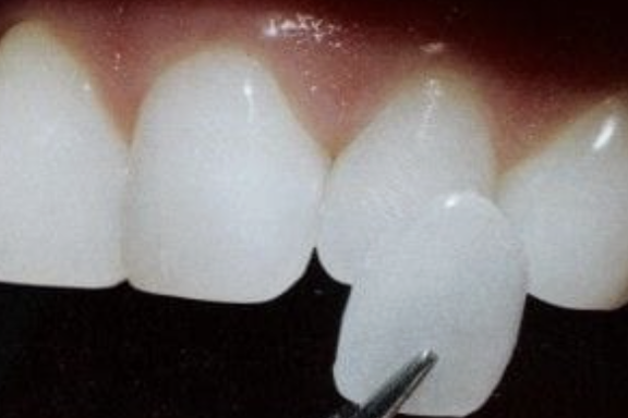 Carillas Dentales grandes