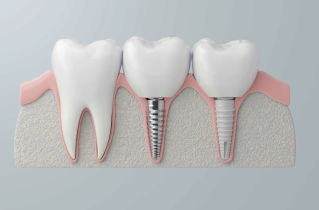 corona dental